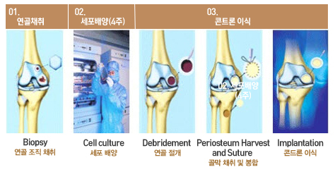 자가연골 배양이식술