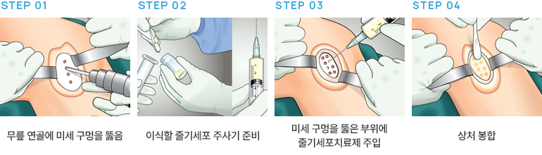 줄기세포