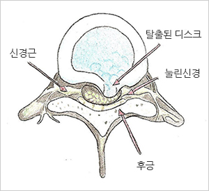디스크탈출그림