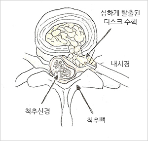 디스크탈출그림