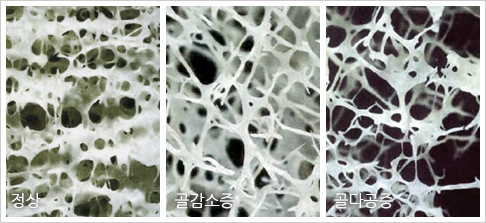 골다공증